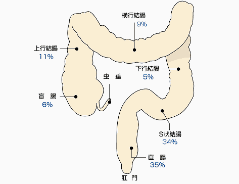 大腸がんの部位別頻度